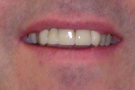 After Whitening and Replacement Crowns