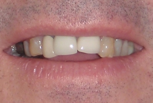 Before Whitening and Replacement Crowns