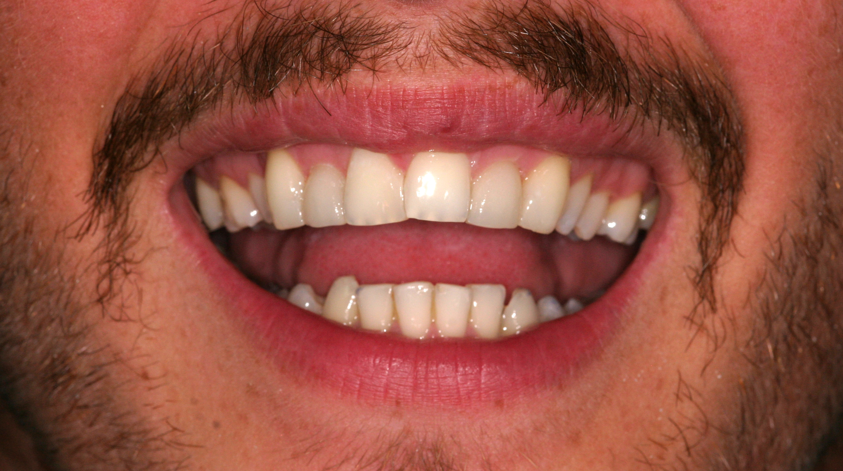 After Porcelain veneers