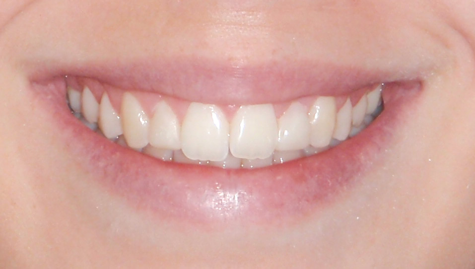 After Composite Veneers