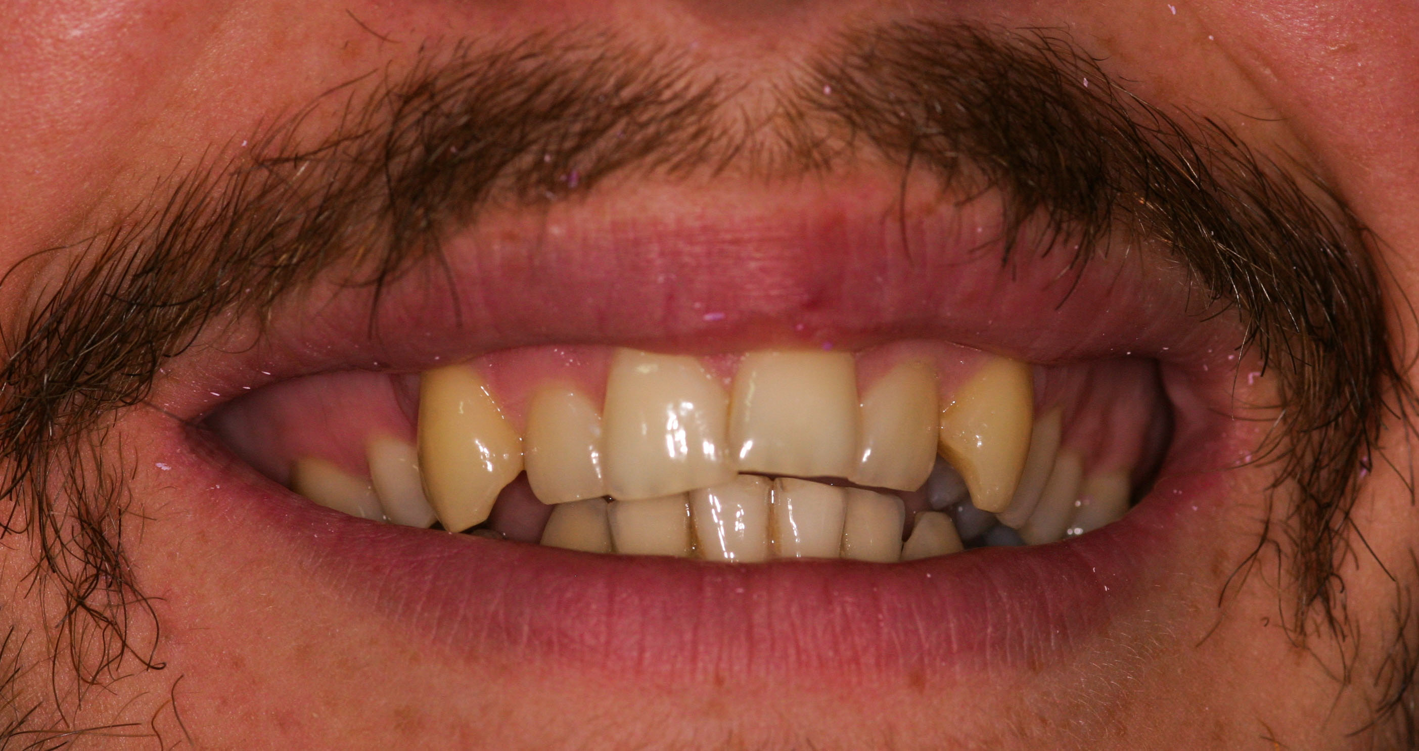 Before Porcelain veneers