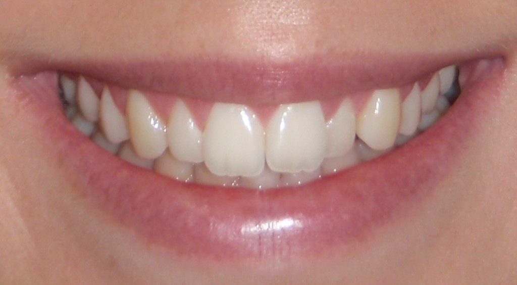 Before Composite Veneers